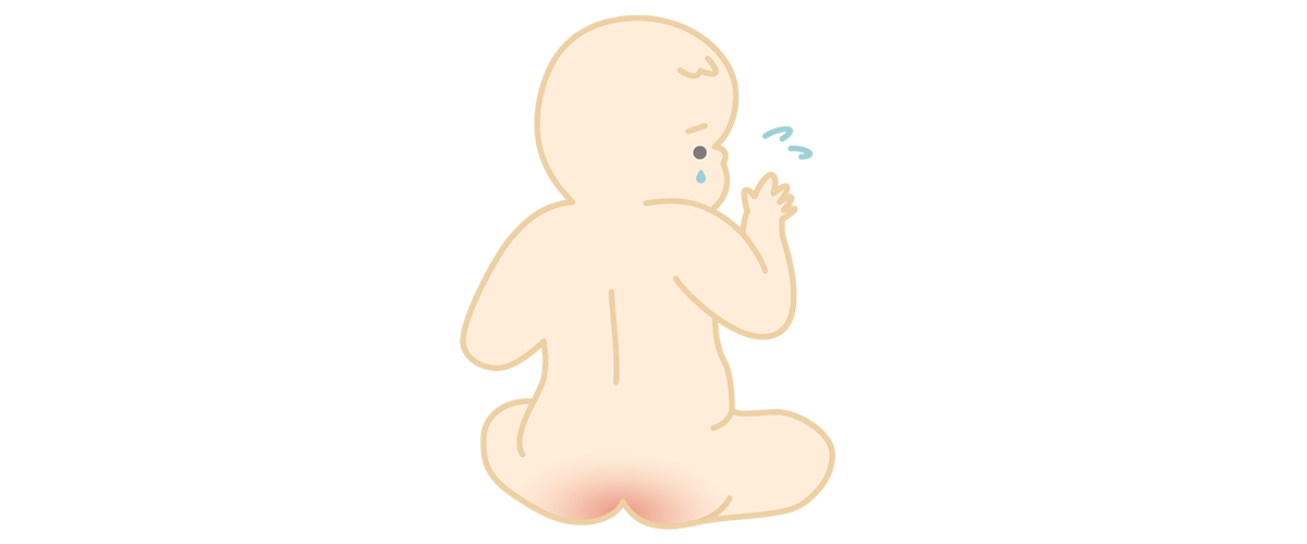 おむつかぶれの原因：おむつかぶれをして、泣いている赤ちゃん