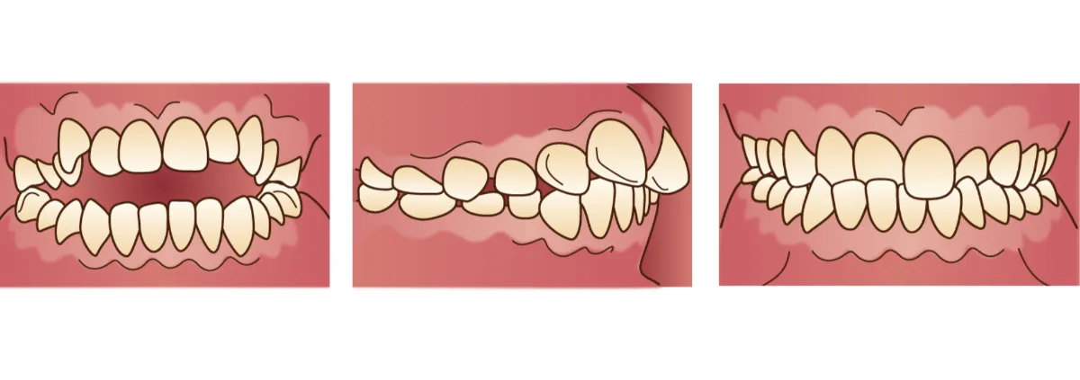 指しゃぶりで歯並びが悪くなるのは本当？月齢別見極めガイド